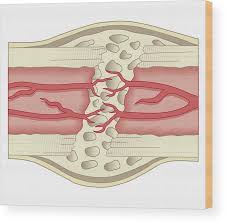 Table 1 describes the bone markings, which are illustrated in (figure 4). Cross Section Biomedical Illustration Of Bone Repairing Itself With New Soft Spongy Callus Developing On Framework Provided By Fibrous Tissue Joining The Broken Ends Wood Print By Dorling Kindersley