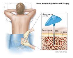 Many people stay away from bone marrow donation, fearing the side effects. Adult Acute Myeloid Leukemia Treatment Pdq Patient Version National Cancer Institute