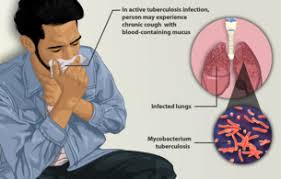 Beberapa penyakit ini begitu buruk bahwa orang bisa mati dari mereka. Tuberkulosis Wikipedia Bahasa Melayu Ensiklopedia Bebas