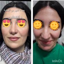 سأكون في مشفى العثمان الجراحي بالاذقية يوم الجمعة ٢٠ الشهر الحالي للتواصل  والحجز واتس 0934968329