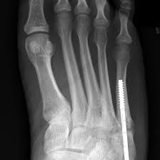 Physical therapy after a jones fracture may help improve your overall foot and ankle range of many times with a jones fracture, the pieces of bone are close together, but with severe fractures, a surgical if you have had orif surgery to reduce your jones fracture, you will have. 4 Type Of Fifth Metatarsal Fracture