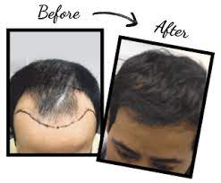 Male and female pattern hair loss is a genetic problem that can leave you feeling helpless. Hair Transplant Hair Loss Clinic Toronto Canadian Hair