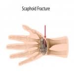 Image result for Scaphoid Fracture Signs