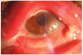 Image result for Gonococcal Conjunctivitis