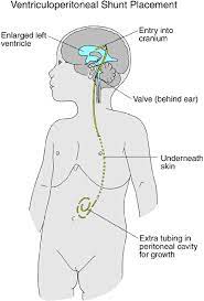 The causes of fainting may be different: Oncology Brain Tumors Children S Wisconsin