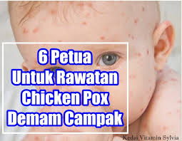 Symptoms of chickenpox begin to appear with shivering, fever, abdominal pain, headache and a general state of malaise. Kedai Vitamin Sylvia 6 Petua Untuk Rawatan Chicken Pox Demam Campak
