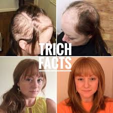 A study of over 5,000 women between the ages of 35 and 60 found that women with excessive hair loss tended to have low iron stores. Womens Hair Loss Causes How Our Enhancer System Can Help Pulling Hair Out Hair Problems Hair Loss Causes
