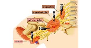 Image result for Axillary Nerve Block