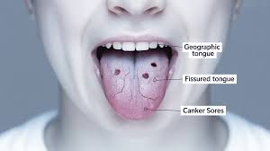Image result for white cancer on tongue)
