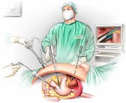 For single incision gastric sleeve surgery, the surgeon uses one single laparoscopic incision that is covered by the belly button. Sydney Gastric Sleeve Surgery Laparoscopic Sleeve Gastrectomy
