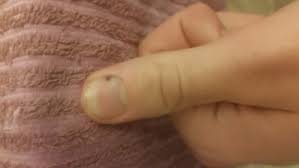 Schwarzer Fleck Unterm Fingernagel Bild Finger Fingernagel
