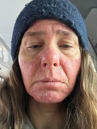 New to the Anti Inflammatory diet, I struggle with chronic inflammation, I  have always done keto or low carb and been successful with weight loss, I  am noticing higher carbs