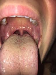 Food stuck in throat won't go down. Something Feels Stuck On Tongue Loads Of Small Papillae Middle Back Tongue Yellow Coating Oesophageal Achalasia And Spasm Forums Patient