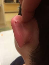 Medical Complications Of Cartilage And Ear Piercing Childrensmd