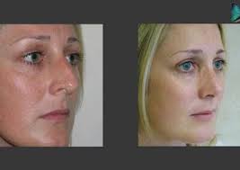 Rhinoplasty Beverly Hills