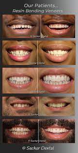 We did not find results for: Cosmetic Dentist Nyc Veneers Nyc Sachar Dental Nyc