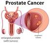 Prostate Cancer | Center for Urologic Care of Berks County
