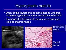 Pin On Thyroide
