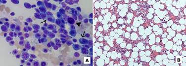 Known to occur in the skeletal of when the sign of infection is malignant, the physician prescribes a biopsy. Scielo Brasil Bone Marrow Bi Hypoplasia In A Dog With A Sertoli Cell Tumor Bone Marrow Bi Hypoplasia In A Dog With A Sertoli Cell Tumor