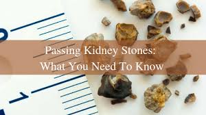 It is highly unlikely that a stone of 8mm will pass on its own. Passing Kidney Stones 101 Urology Specialists Nc