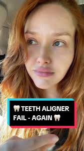 Backtracking again 😩 Is anyone else struggling to successfully finish  their #teethaligners ?! …5th times a charm I hope 🦷✨ #aligners  #toothalignment #orthodontics #byte #invisalign #smile #dentist ...