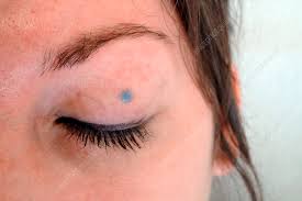 Image result for Blue Nevus