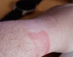 Dec 31, 2019 · trapped moisture and bacteria are the most likely causes of discomfort. Galaxy Watch Users Complaining About Skin Rashes And Battery Issues Piunikaweb