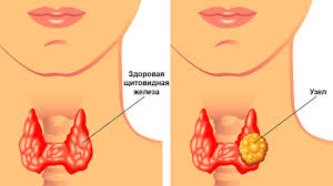 Узлы в щитовидной железе. Удалять или не удалять? | Новости Таджикистана  ASIA-Plus