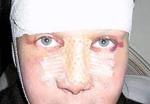 A partir de un presupuesto límite o una. Rhinoplastik Wikipedia
