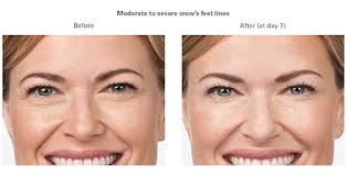 I would absolutely recommend this treatment to someone looking for a way to this is super interesting! Botox Aesthetica Skin Health Center
