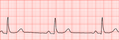 Paroxysmal atrial flutter or fibrillation may also occur).2. Bradycardia Wikipedia