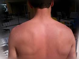 Myofascial Pain Syndrome Uncovering The Root Causes