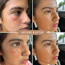 Image result for Photodermatitis
