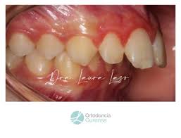 We did not find results for: Dispositivo De Avance Mandibular En Ninos Ortodoncia Ourense