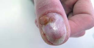 Image result for Akutní zánět nehtového lůžka