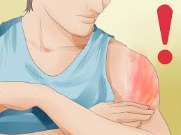 Enough paying carpet cleaners or carpet repairs. How To Treat Carpet Burns With Pictures Wikihow