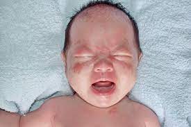 Bila ruam bayi disertai ruam yang sering dialami bayi, penyebab, dan penanganannya. 5 Jenis Ruam Yang Sering Terjadi Pada Bayi Dan Cara Mengatasinya Bukareview