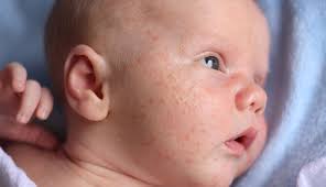 Image result for yellow scabs on the face in children