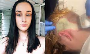 Another common chemical found in hair dye is para toluenediamine ptd which can be tolerated better than ppd but may still cause an how to cure chemical burn from hair dye with herbal treatment. Woman Suffers Shocking Chemical Burns From Diy Hair Bleaching Daily Mail Online