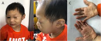 Diagnosis delay a family of Galloway-Mowat Syndrome caused by a classical  splicing mutation of Lage3