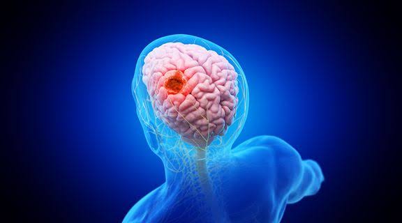 Tipos de tumor cerebral: quais são e sintomas | Rede Américas