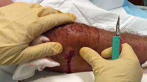 The sepsis disease is hard to diagnose, and becomes life threatening, if not detected early. Arm Infection And Sepsis Youtube