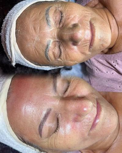 Enzima Botox