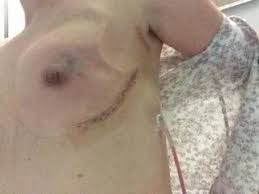 My mom had breast cancer 8 years ago. Woman Shares Details And Photos Of Pre Emptive Bilateral Mastectomy On Reddit To Help Other Women Huffpost Uk Life