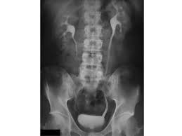 Image result for Intravenous Pyelogram