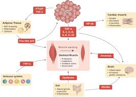 Image result for Cachexia in Cancer
