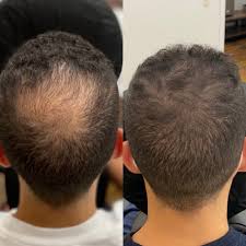 Samvardhana motherson peguform (smp) is a leading expert in high quality interior and exterior modules for the automotive industry. Smp Scalp Pro Sioux Falls Sd