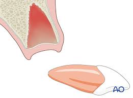 Image result for Tooth Luxation