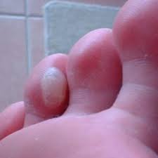 Como Curar Las Ampollas En Manos Y Pies 9 Pasos
