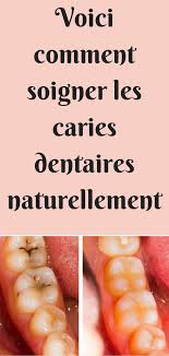 Non soignée, la carie évolue en profondeur. C Est Le Moyen Naturel De Traiter La Carie Dentaire Esprit Sante Dentaire Soigner La Carie Dentaire Comment Soigner